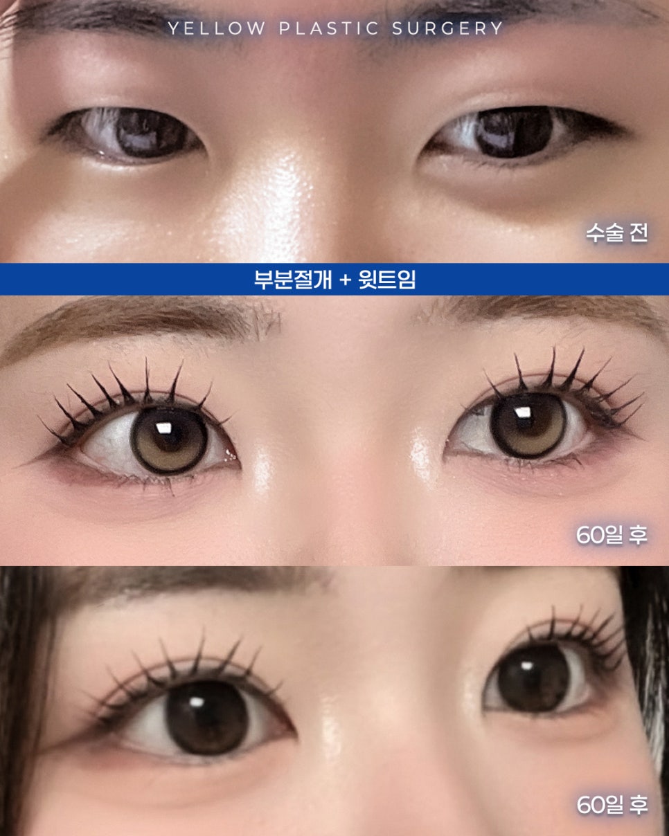 [ 강남역 옐로우성형외과 / 눈성형 ] 부분절개 + 윗트임 관련 이미지 1
