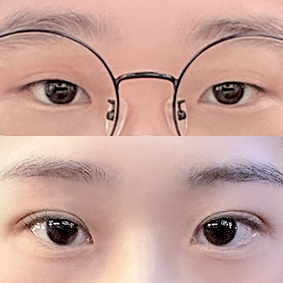 [ 강남역 옐로우성형외과 / 눈성형 ]  자연유착 눈수술 쌍수 후기 관련 이미지 1
