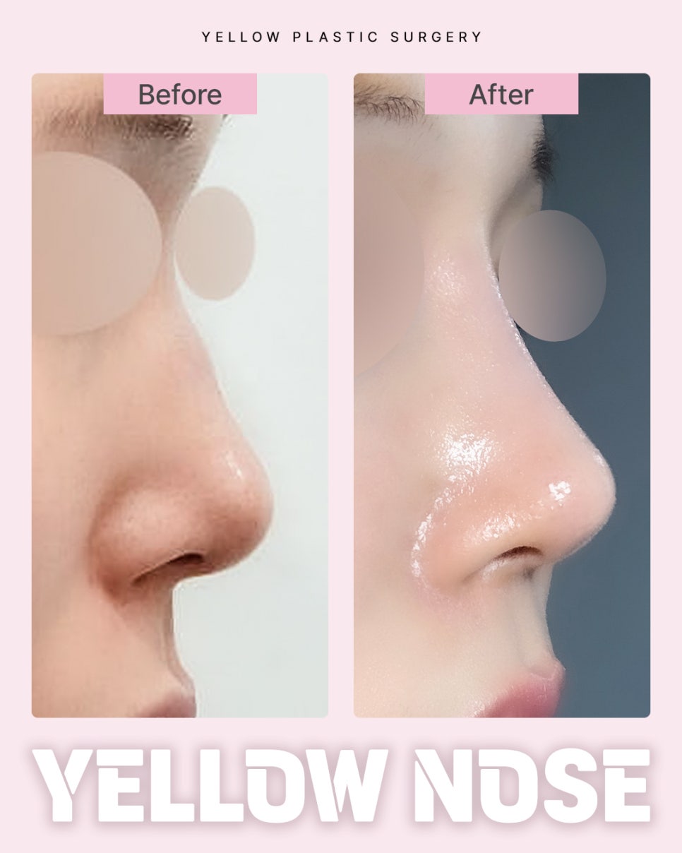 Gangnam Station Yellow Plastic Surgery / Rhinoplasty image 1