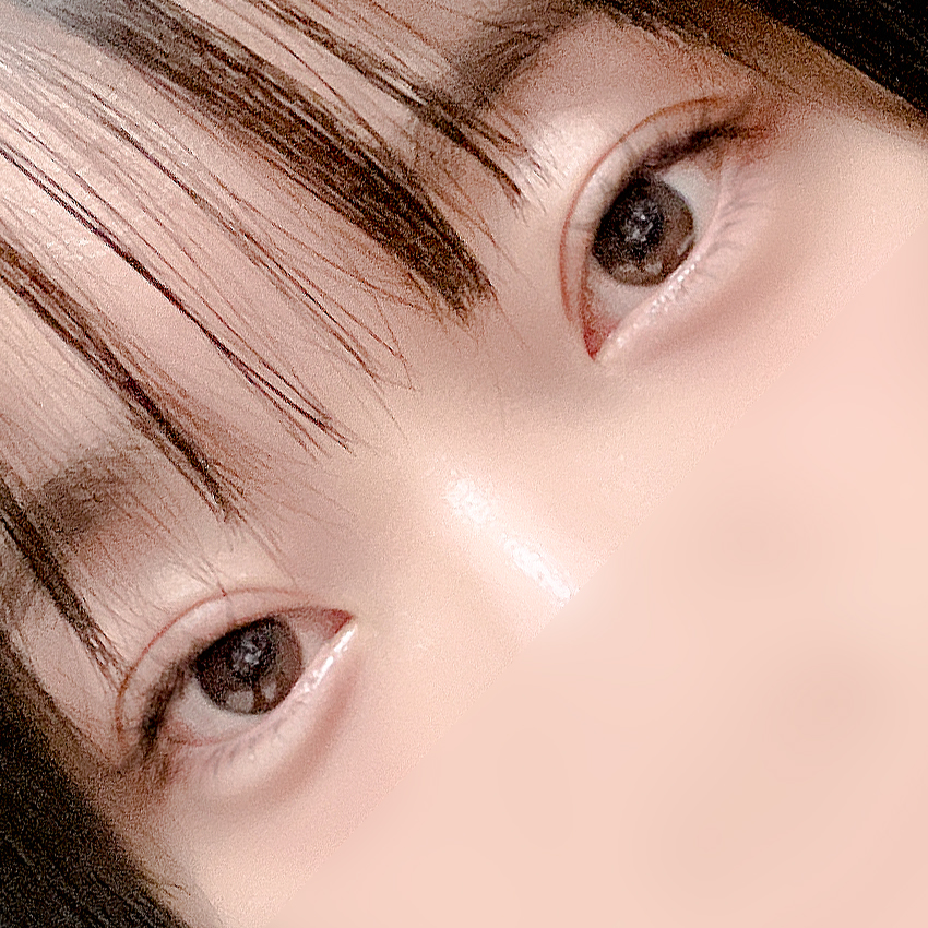 [Gangnam Station Yellow Plastic Surgery / Eye Surgery] Seven-Month Review After First Partial Incision Surgery: Improvement in Uneven Eyes image 5
