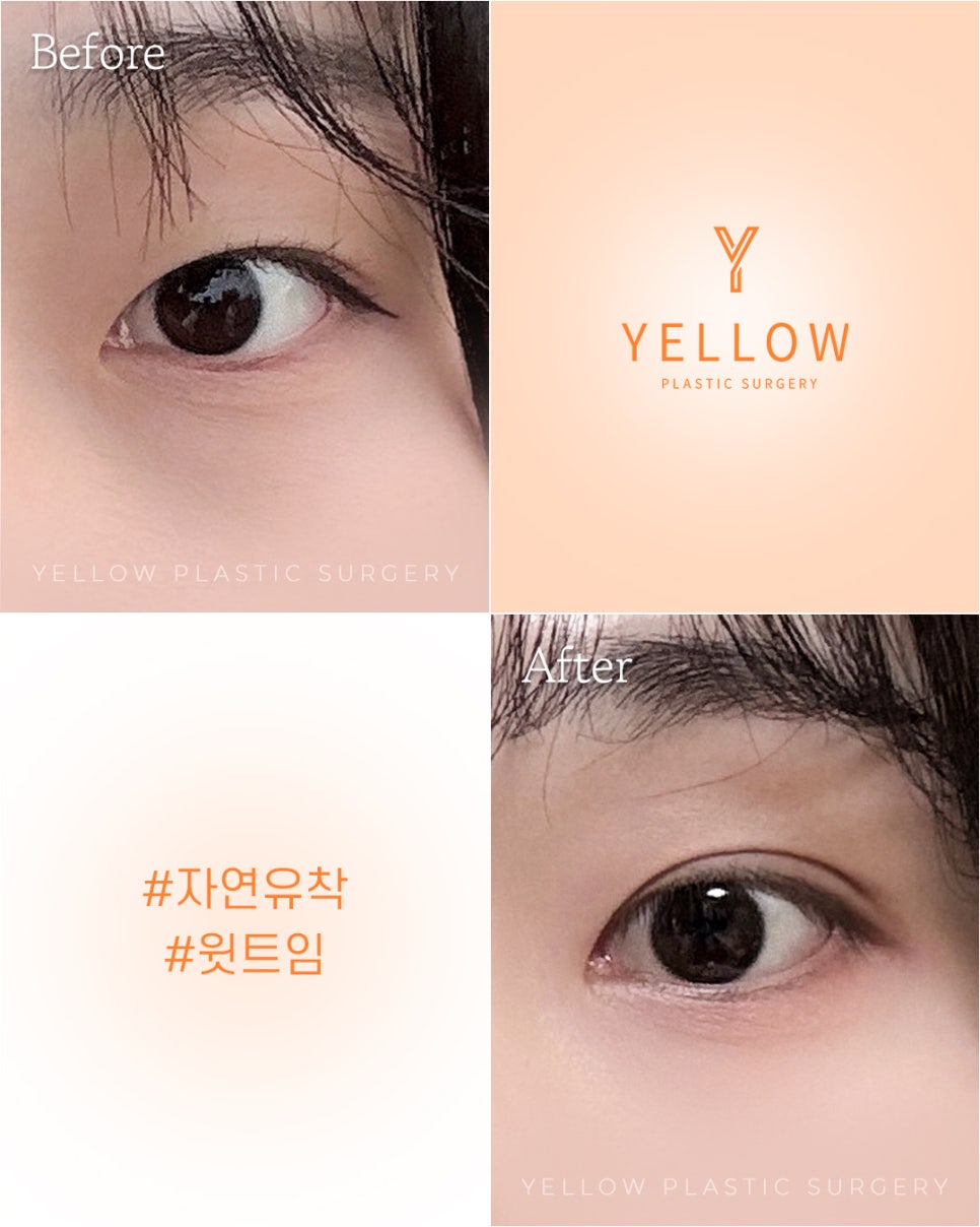 [Gangnam Station Yellow Plastic Surgery / Eye Surgery] Natural Adhesion + Upper Epicanthoplasty image 1