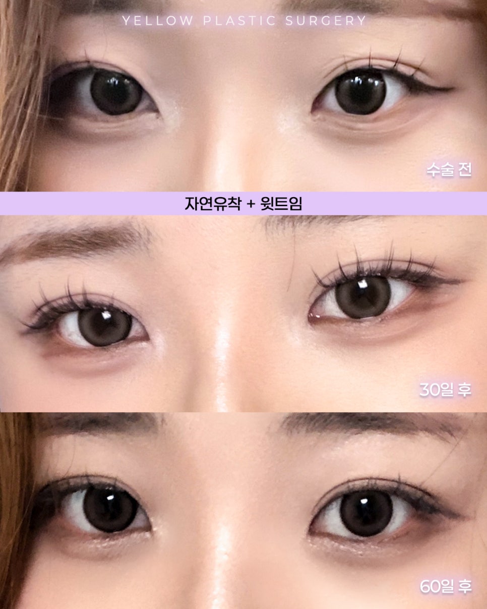 [ Gangnam Station Yellow Plastic Surgery / Eyelid Surgery ] Natural Adhesion + Upper Canthoplasty image 1