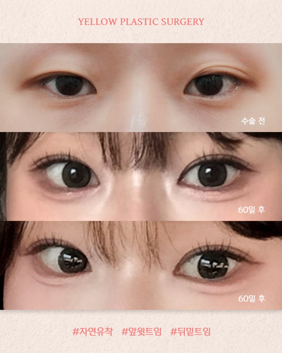 [ 강남역 옐로우성형외과 / 눈성형 ] 자연유착 + 앞윗트임 +뒤밑트임 관련 이미지 1