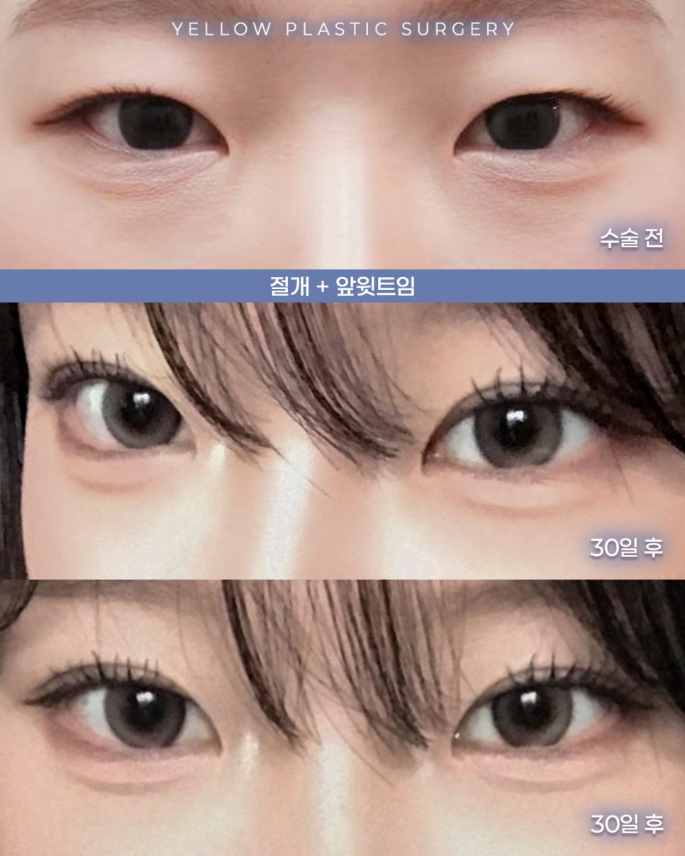 [ 강남역 옐로우성형외과 / 눈성형 ] 절개 + 앞윗트임 관련 이미지 1