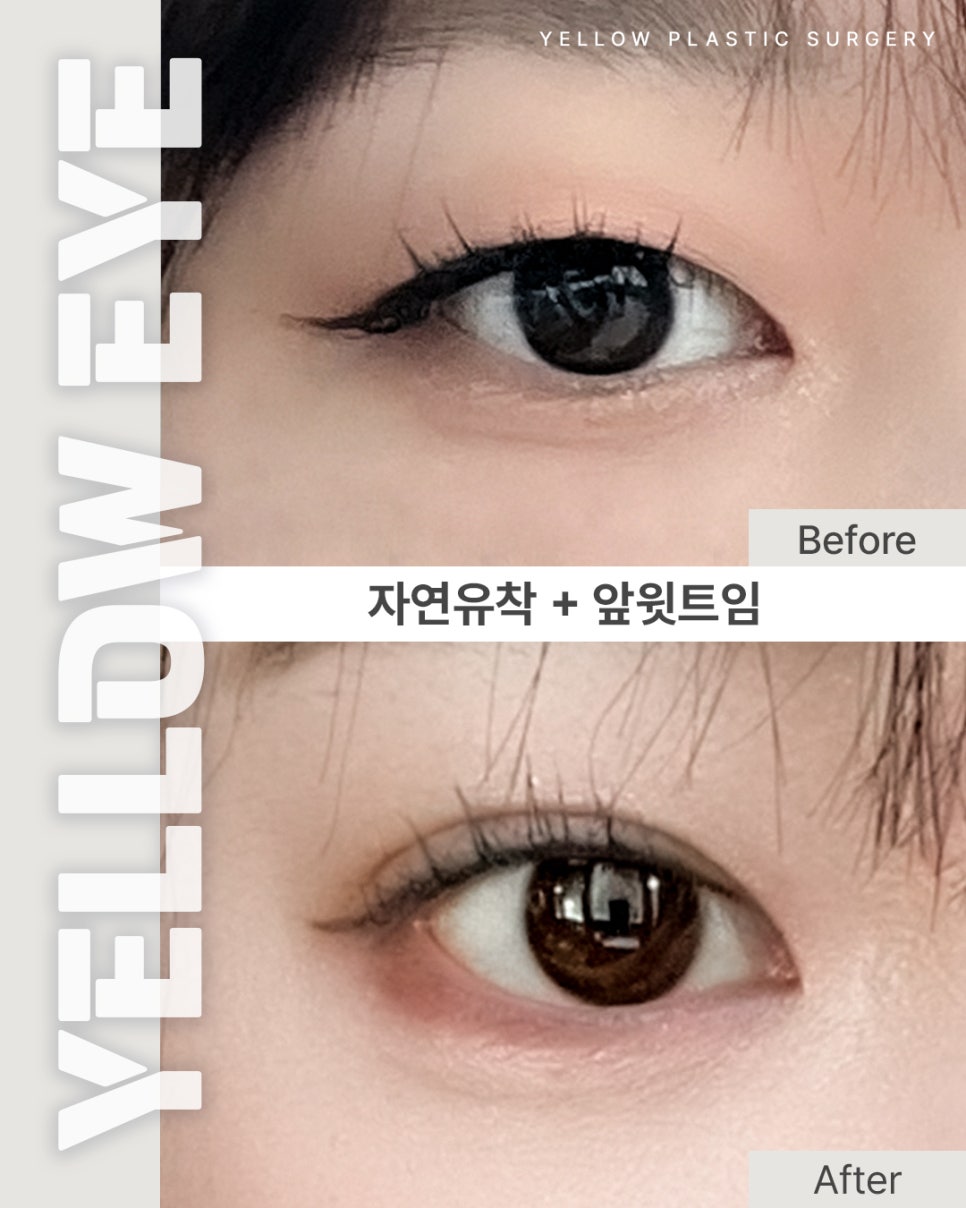 [ 강남역 옐로우성형외과 / 눈성형 ] 자연유착 + 앞윗트임 관련 이미지 1