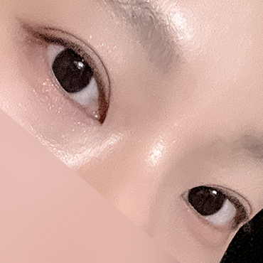 [ 강남역 옐로우성형외과 / 눈성형 ] 부분절개 재수술 후기 관련 이미지 7