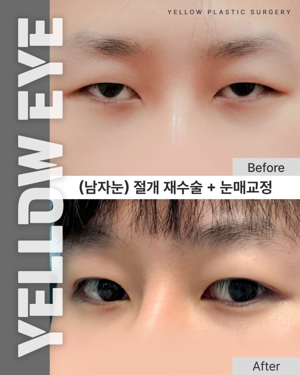 [ Gangnam Station Yellow Plastic Surgery / Eye Surgery ] (Male Eyes) Incisional Revision Surgery + Eye Shape Correction image 1