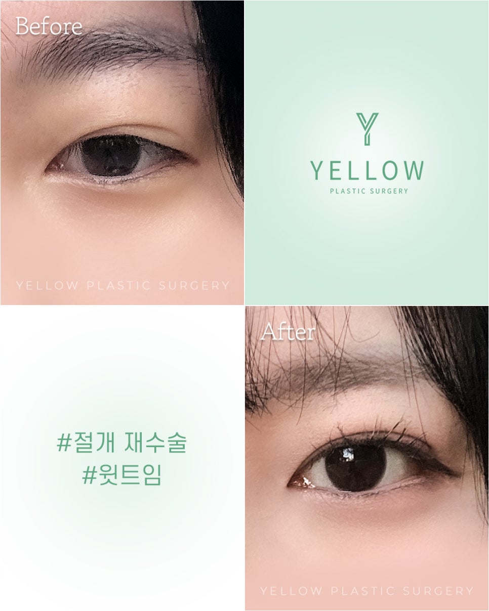 [ 강남역 옐로우성형외과 / 눈성형 ] 절개 재수술 + 윗트임 관련 이미지 1