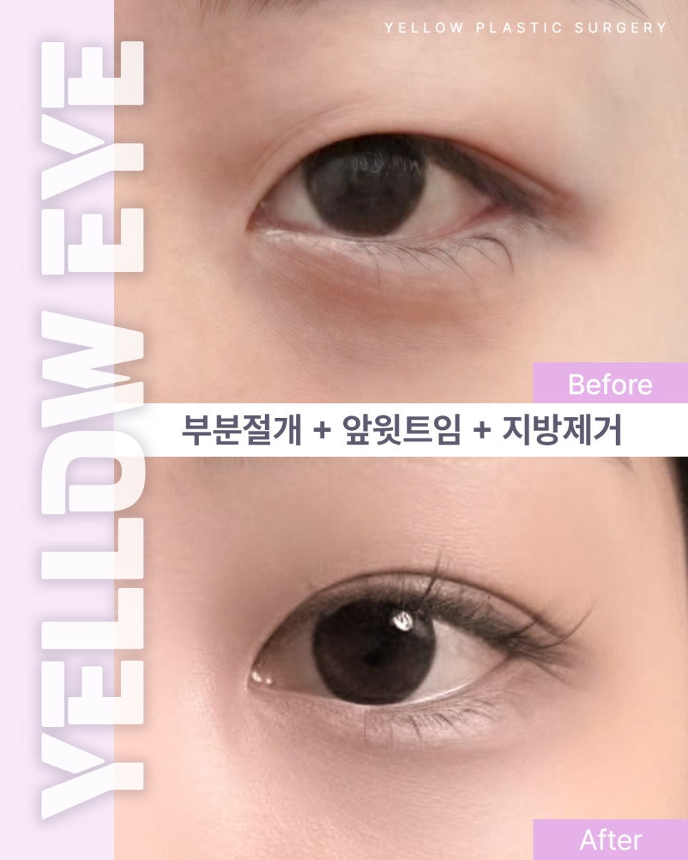 [Gangnam Station Yellow Plastic Surgery / Eye Surgery] Partial Incision + Inner Upper Eyelid Epicanthoplasty + Fat Removal image 1