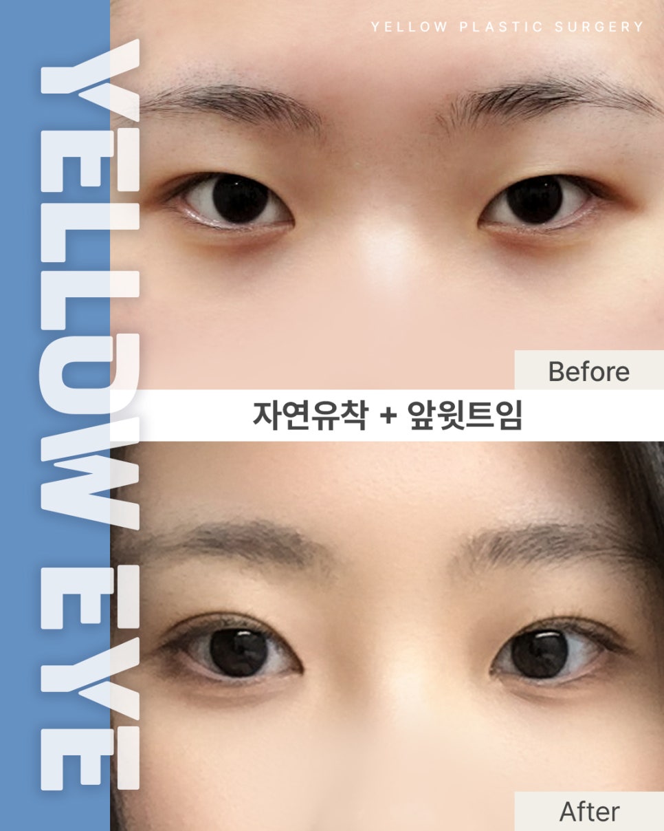 [ 강남역 옐로우성형외과 / 눈성형 ] 자연유착 + 앞윗트임 관련 이미지 1