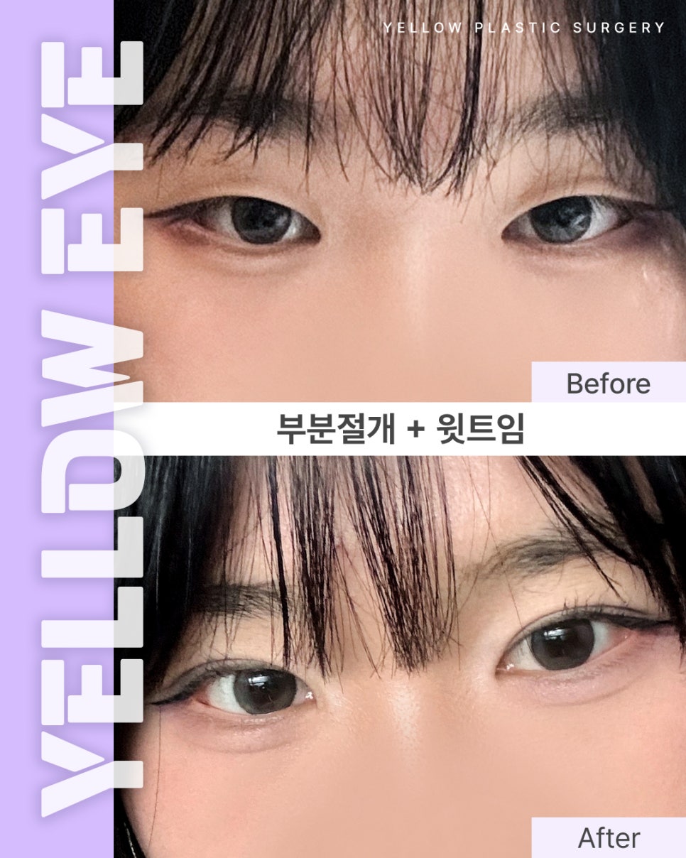 [ 강남역 옐로우성형외과 / 눈성형 ] 부분절개 + 윗트임 관련 이미지 1