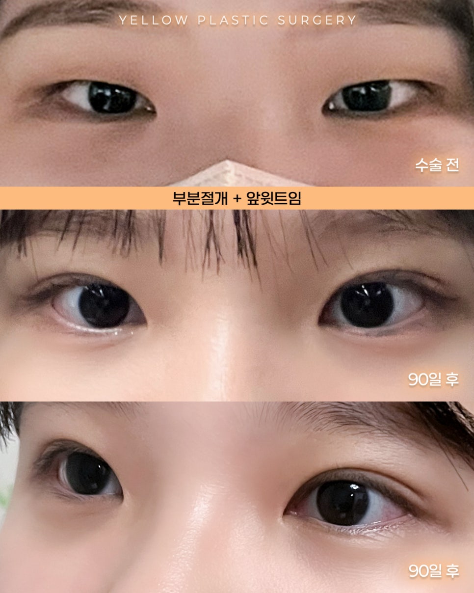 [ Gangnam Station Yellow Plastic Surgery Clinic / Eye Surgery ] Partial Incision + Upper Inner Corner Revision image 1