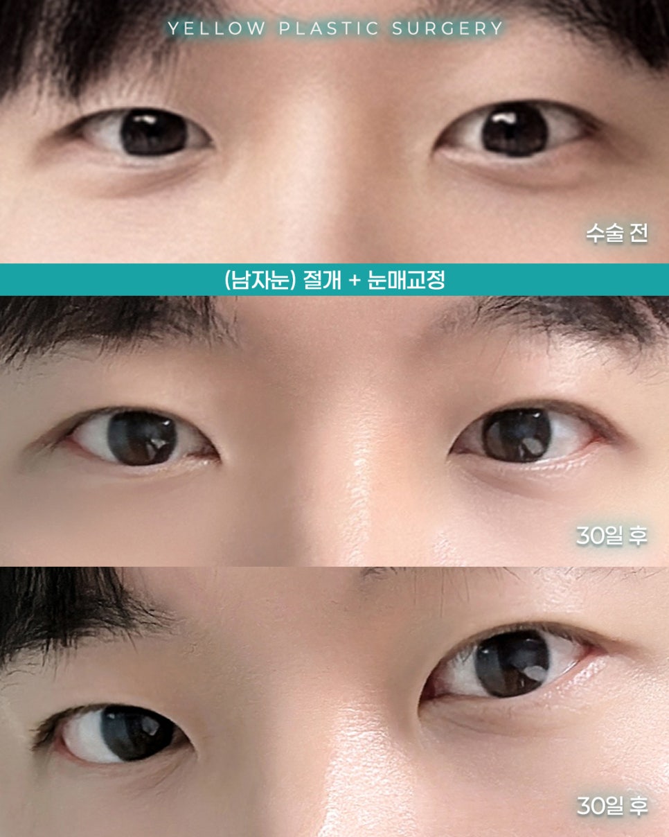 [ 강남역 옐로우성형외과 / 눈성형 ] (남자눈) 절개 + 눈매교정 관련 이미지 1