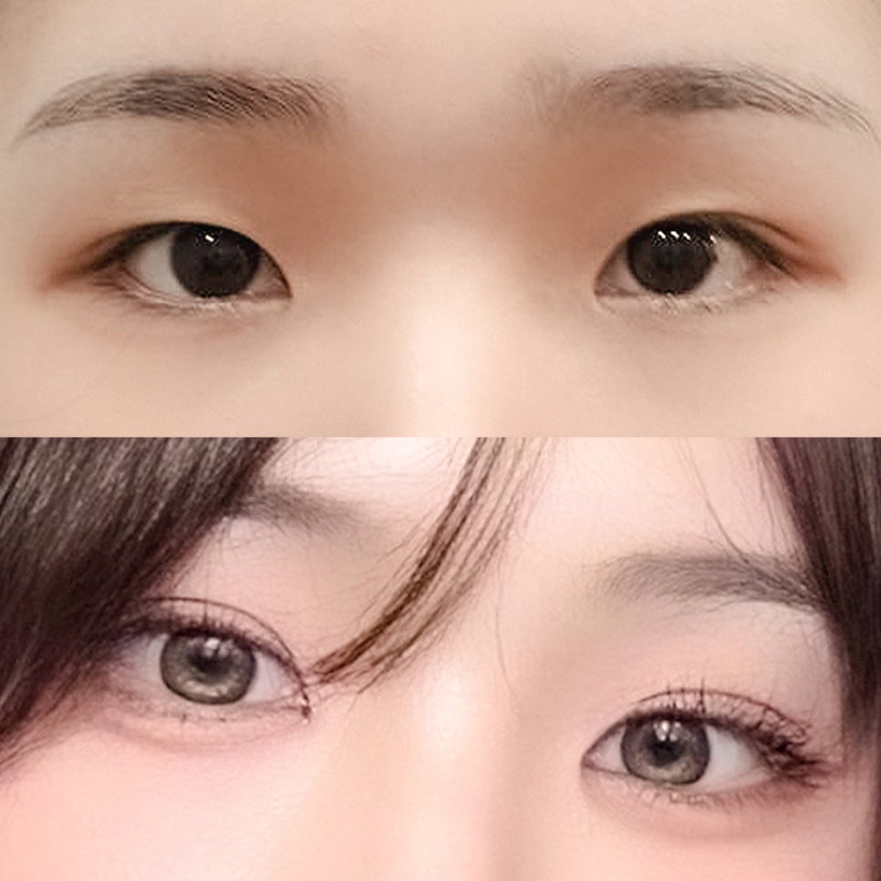 [ 강남역 옐로우성형외과 / 눈성형 ] 자연유착 앞트임 윗트임 수술 후기 관련 이미지 1