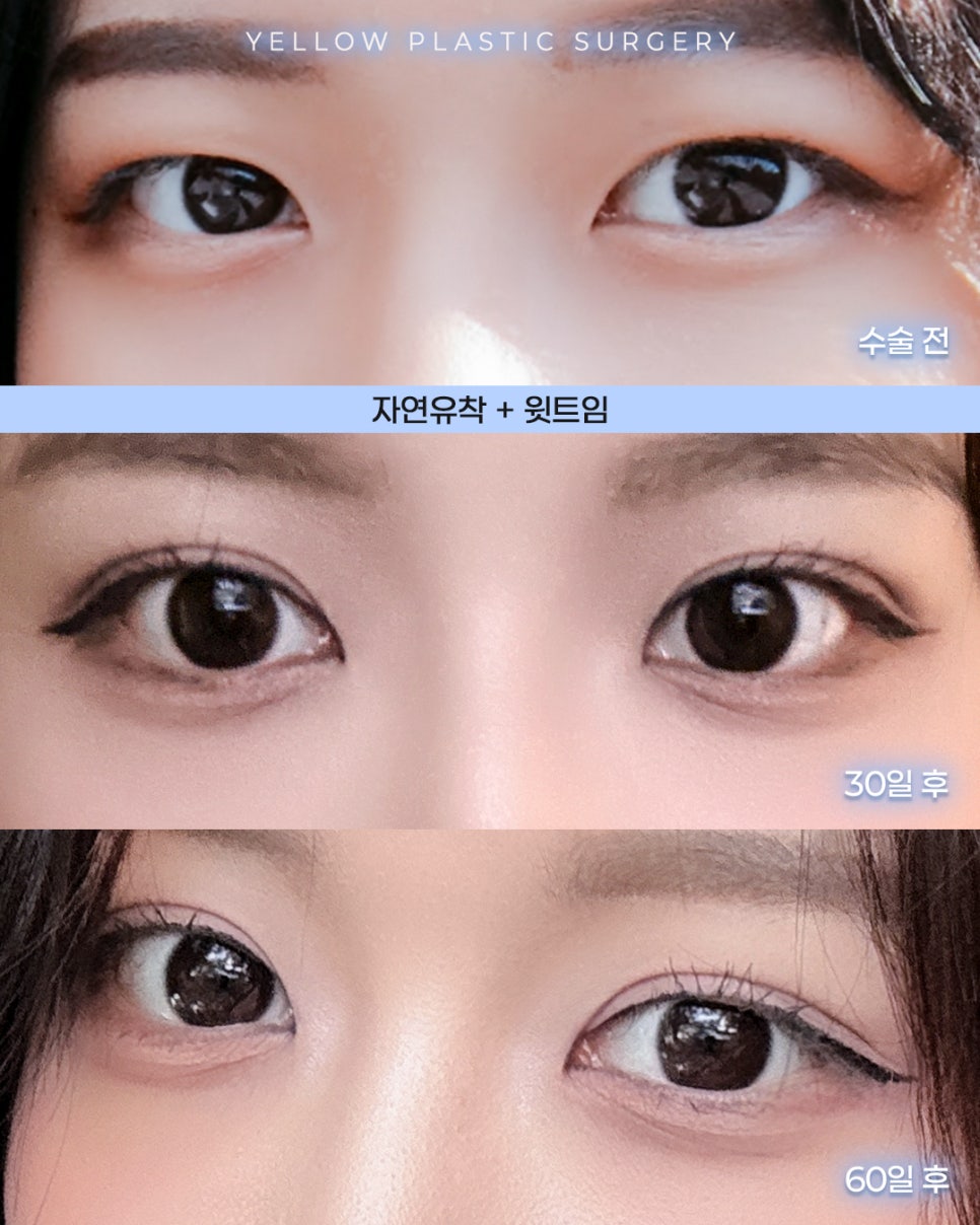 [ 강남역 옐로우성형외과 / 눈성형 ] 자연유착 + 윗트임 관련 이미지 1