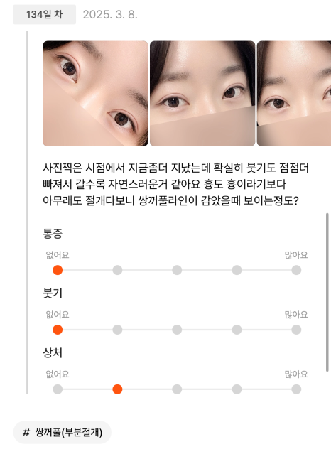 [Gangnam Station Yellow Plastic Surgery / Eye Surgery] Seven-Month Review After First Partial Incision Surgery: Improvement in Uneven Eyes image 3