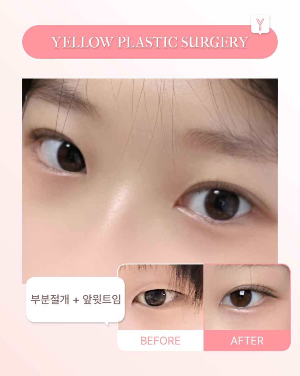 [ 강남역 옐로우성형외과 / 눈성형 ] 부분절개 + 앞윗트임 관련 이미지 1