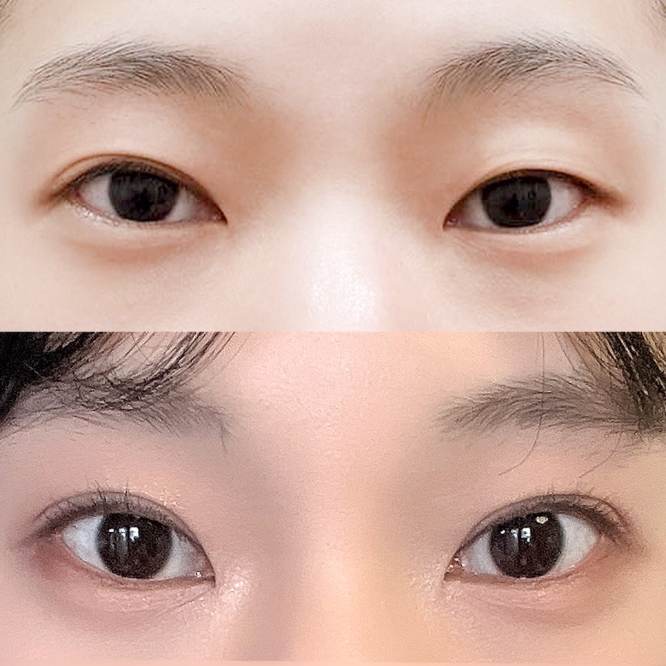 [ 강남역 옐로우성형외과 / 눈성형 ] 부분절개 재수술 후기 관련 이미지 1