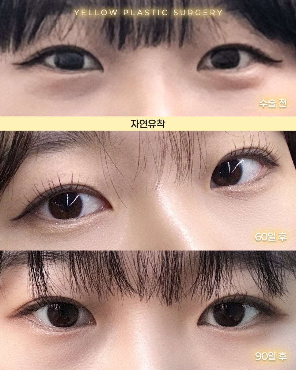 [ 강남역 옐로우성형외과 / 눈성형 ] 자연유착 관련 이미지 1