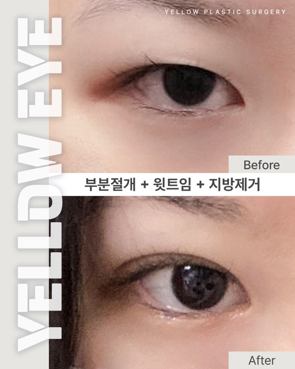 [ 강남역 옐로우성형외과 / 눈성형 ] 부분절개 + 윗트임 + 지방제거 관련 이미지 1
