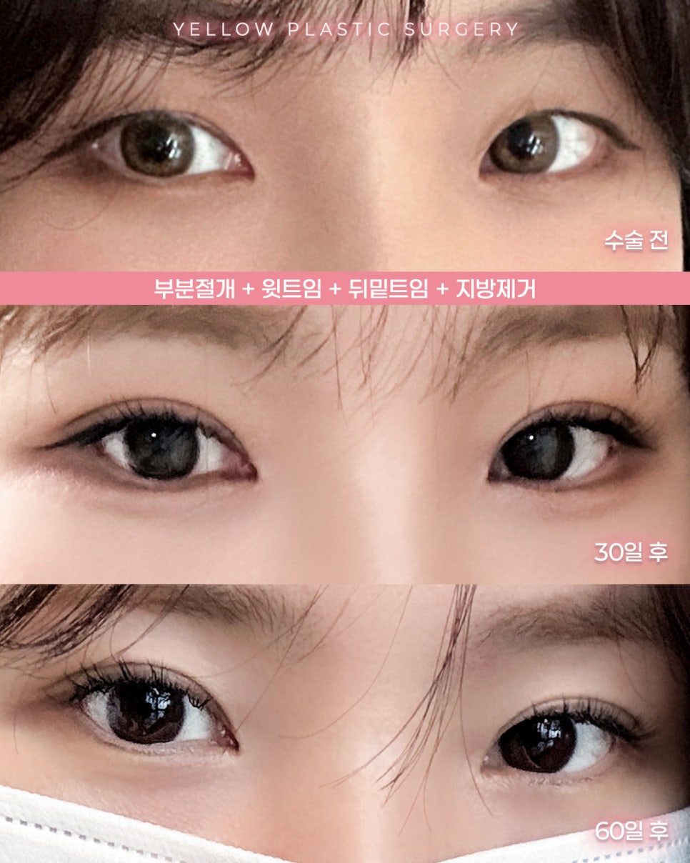 [Gangnam Station Yellow Plastic Surgery / Eye Plastic Surgery] Partial Incision + Upper Canthoplasty + Lateral/Lower Canthoplasty + Fat Removal image 1