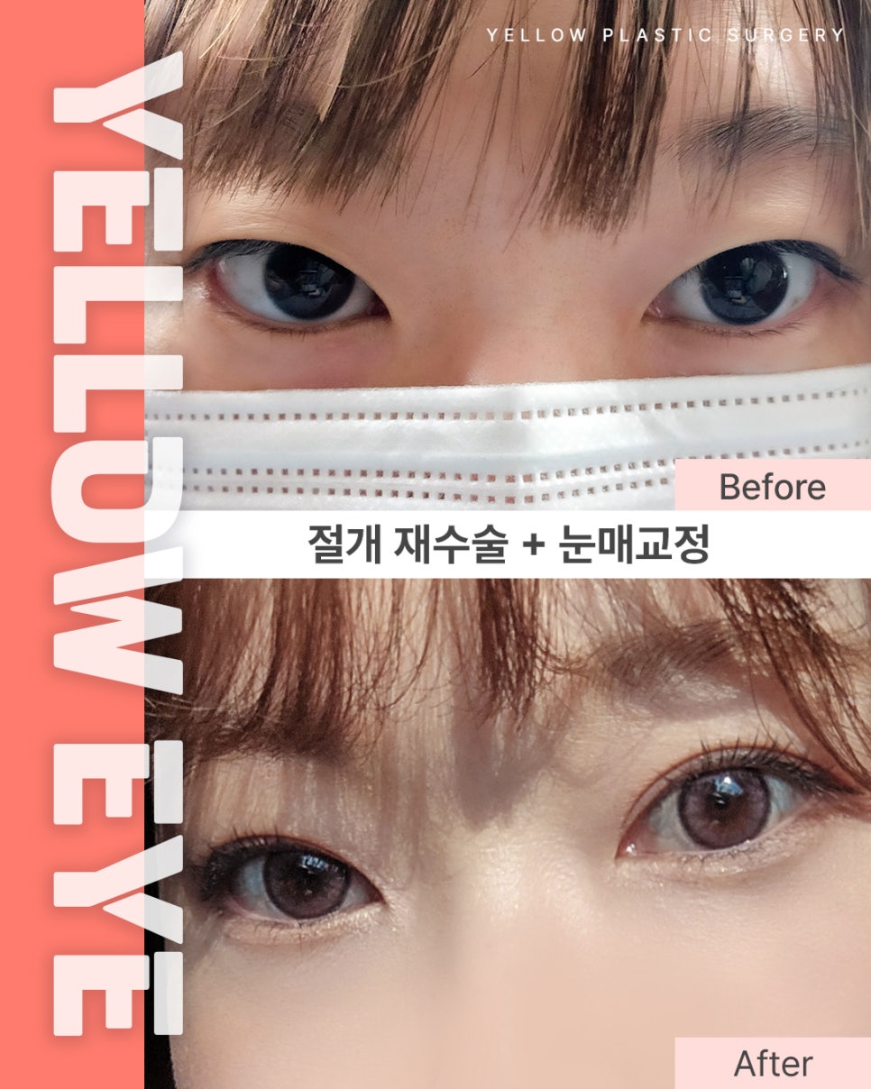 [ 강남역 옐로우성형외과 / 눈성형 ] 절개 재수술 + 눈매교정 관련 이미지 1