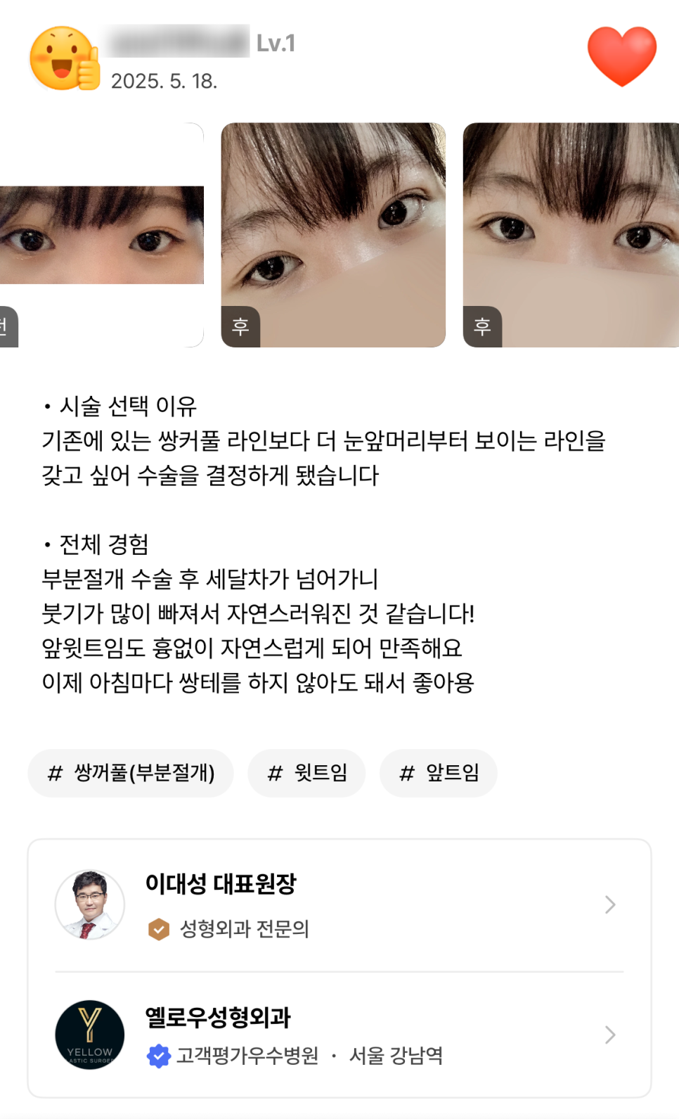 [ 강남역 옐로우성형외과 / 눈성형 ]  부분절개 앞트임 윗트임 수술 후기 2개월차 4개월차 관련 이미지 2