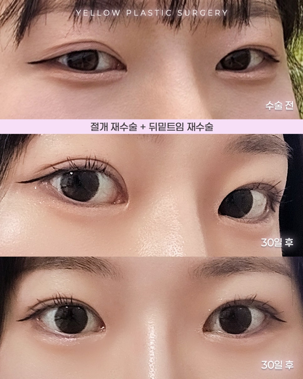 [ Gangnam Station Yellow Plastic Surgery / Eye Surgery ] Revision Incisional Surgery + Revision Lateral and Lower Canthoplasty image 1