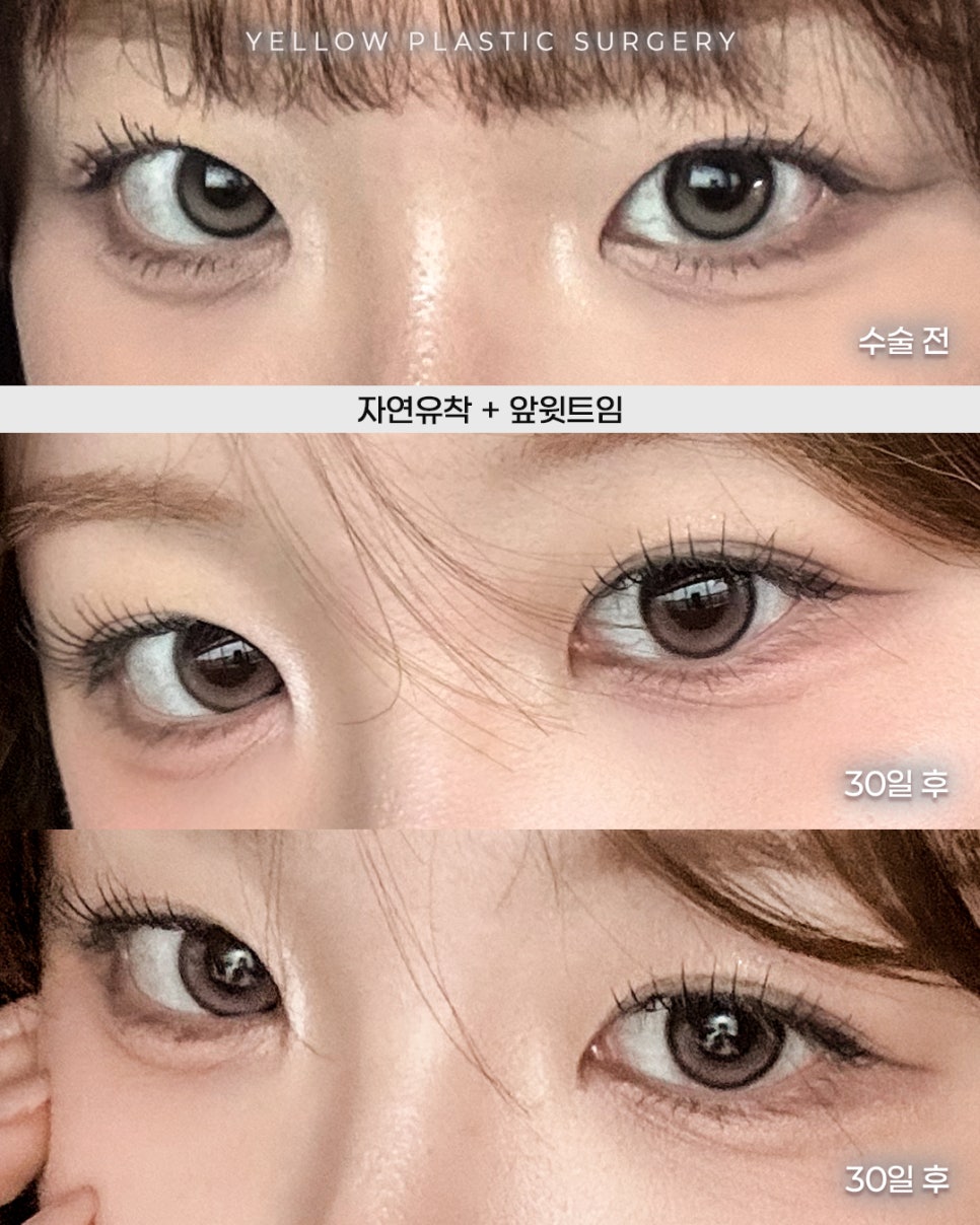 [ 강남역 옐로우성형외과 / 눈성형 ] 자연유착 + 앞윗트임 관련 이미지 1