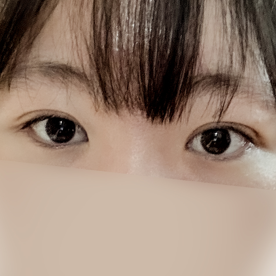 [ 강남역 옐로우성형외과 / 눈성형 ]  부분절개 앞트임 윗트임 수술 후기 2개월차 4개월차 관련 이미지 6