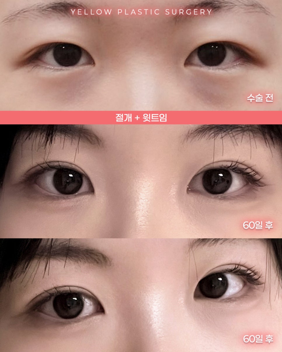 [ 강남역 옐로우성형외과 / 눈성형 ] 절개 + 윗트임 관련 이미지 1