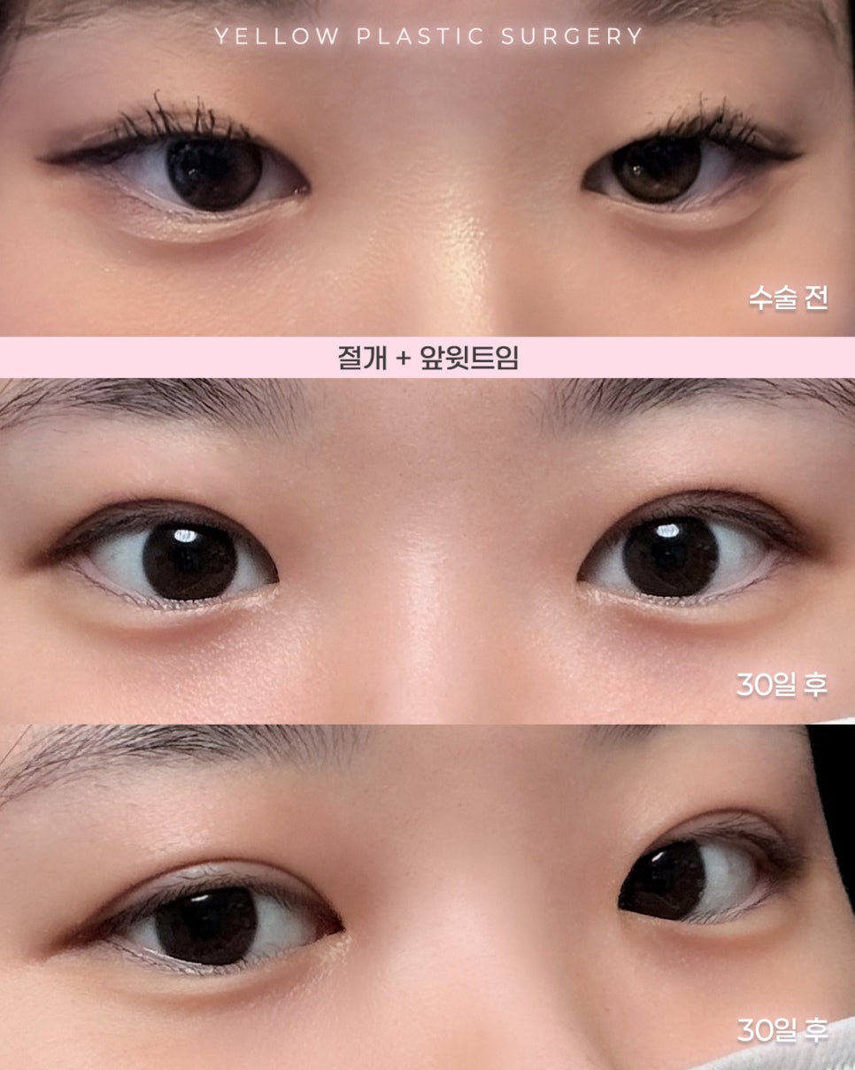 [ Gangnam Station Yellow Plastic Surgery / Eye Surgery ] Incisional Double Eyelid Surgery + Upper Medial Canthoplasty image 1