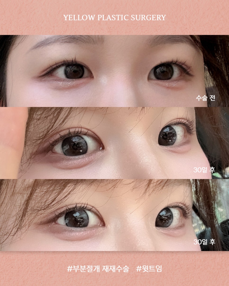 [ 강남역 옐로우성형외과 / 눈성형 ] 부분절개 재재수술 + 윗트임 관련 이미지 1