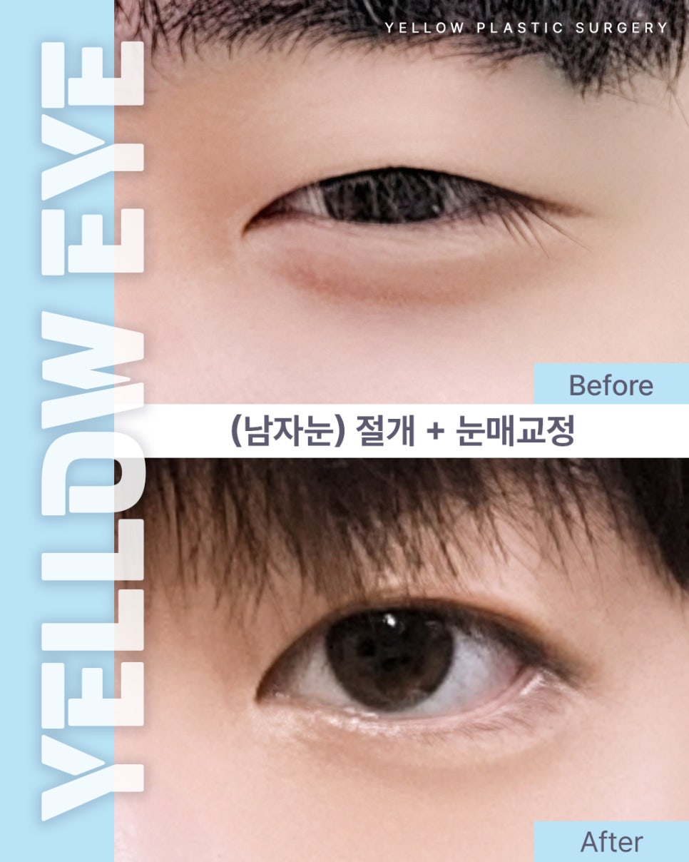 [ 강남역 옐로우성형외과 / 눈성형 ] (남자눈) 절개 + 눈매교정 관련 이미지 1