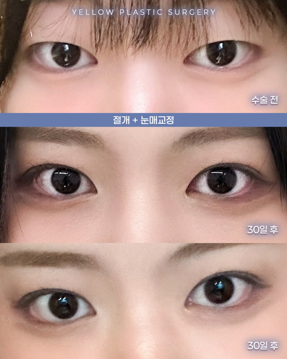 [ 강남역 옐로우성형외과 / 눈성형 ] 절개 + 눈매교정 관련 이미지 1