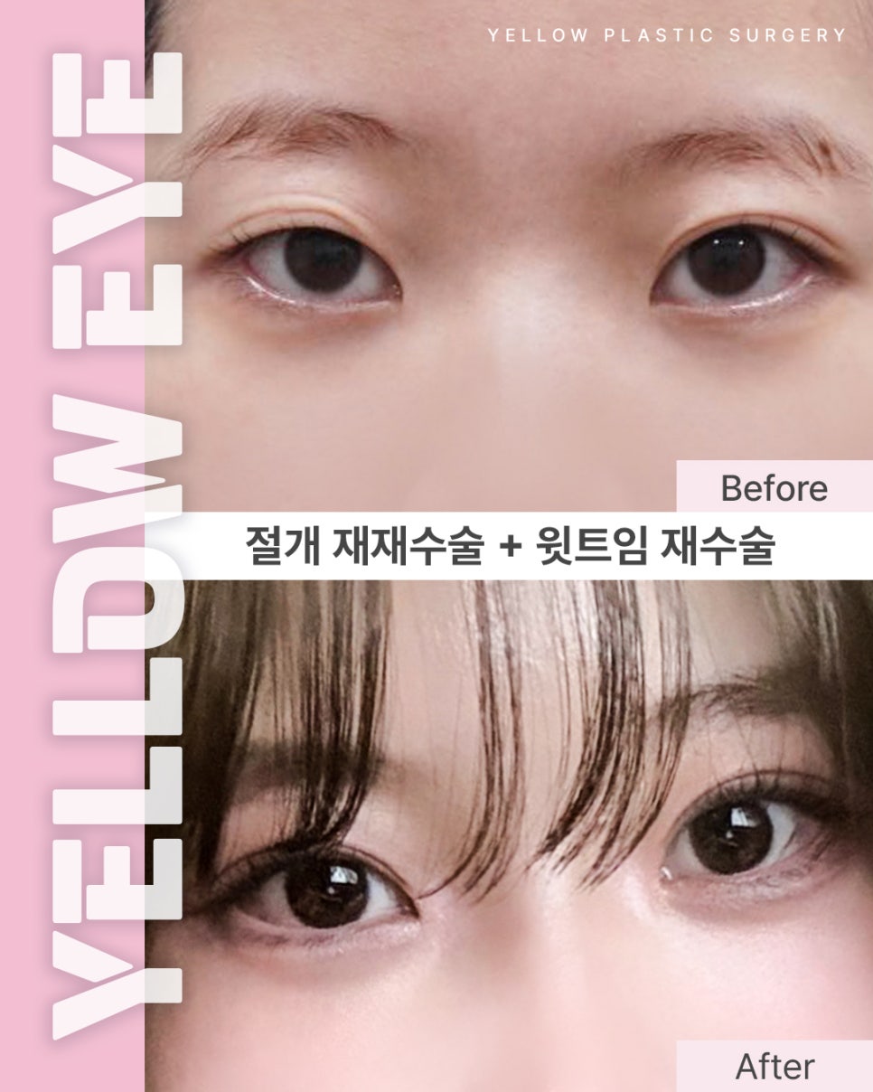 [Gangnam Station Yellow Plastic Surgery / Eye Surgery] Secondary Secondary Incision Surgery + Upper Canthoplasty Revision Surgery image 1