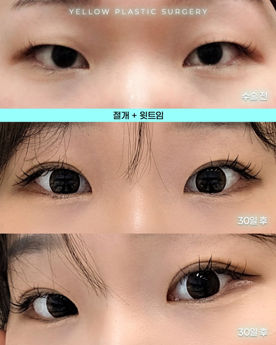 [ 강남역 옐로우성형외과 / 눈성형 ] 절개 + 윗트임 관련 이미지 1