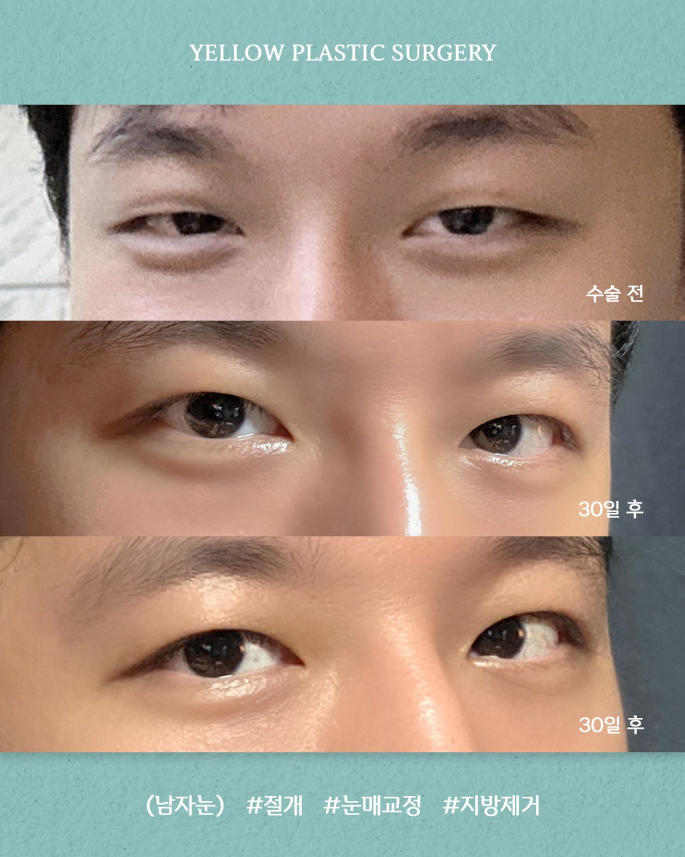 [ 강남역 옐로우성형외과 / 눈성형 ] (남자눈) 절개 + 눈매교정 + 지방제거 관련 이미지 1