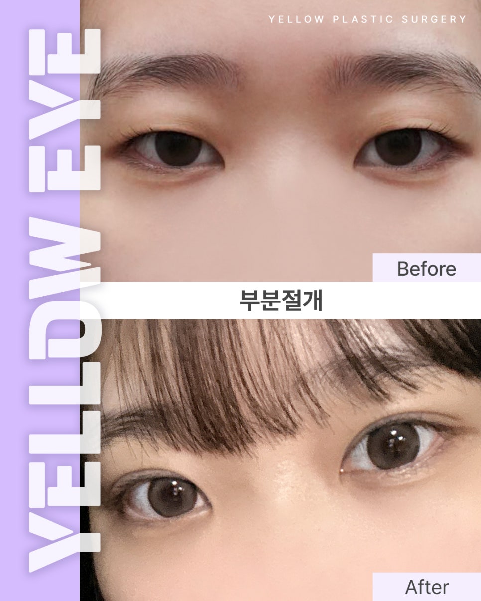 [ 강남역 옐로우성형외과 / 눈성형 ] 부분절개 관련 이미지 1