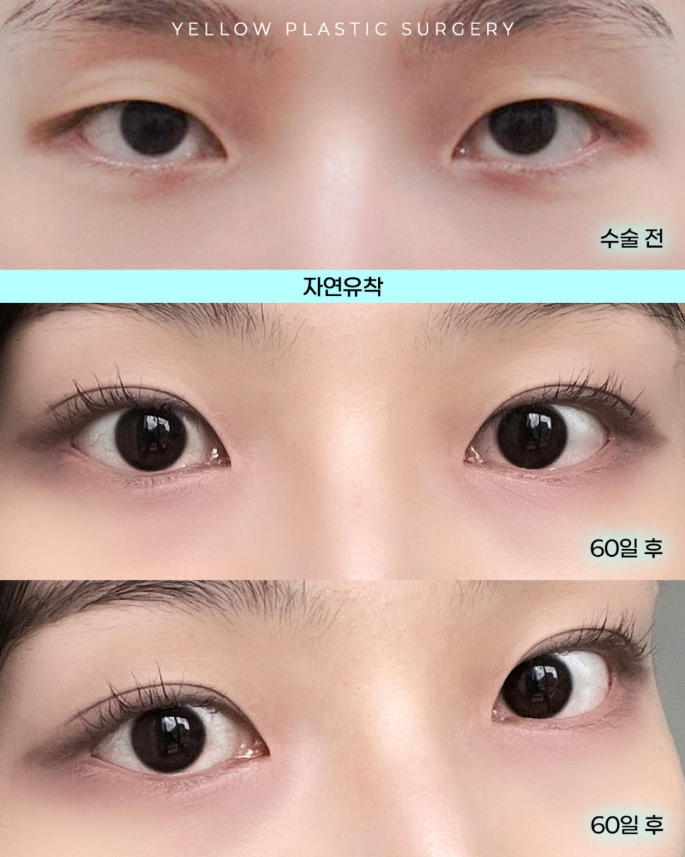 [ 강남역 옐로우성형외과 / 눈성형 ] 자연유착 관련 이미지 1