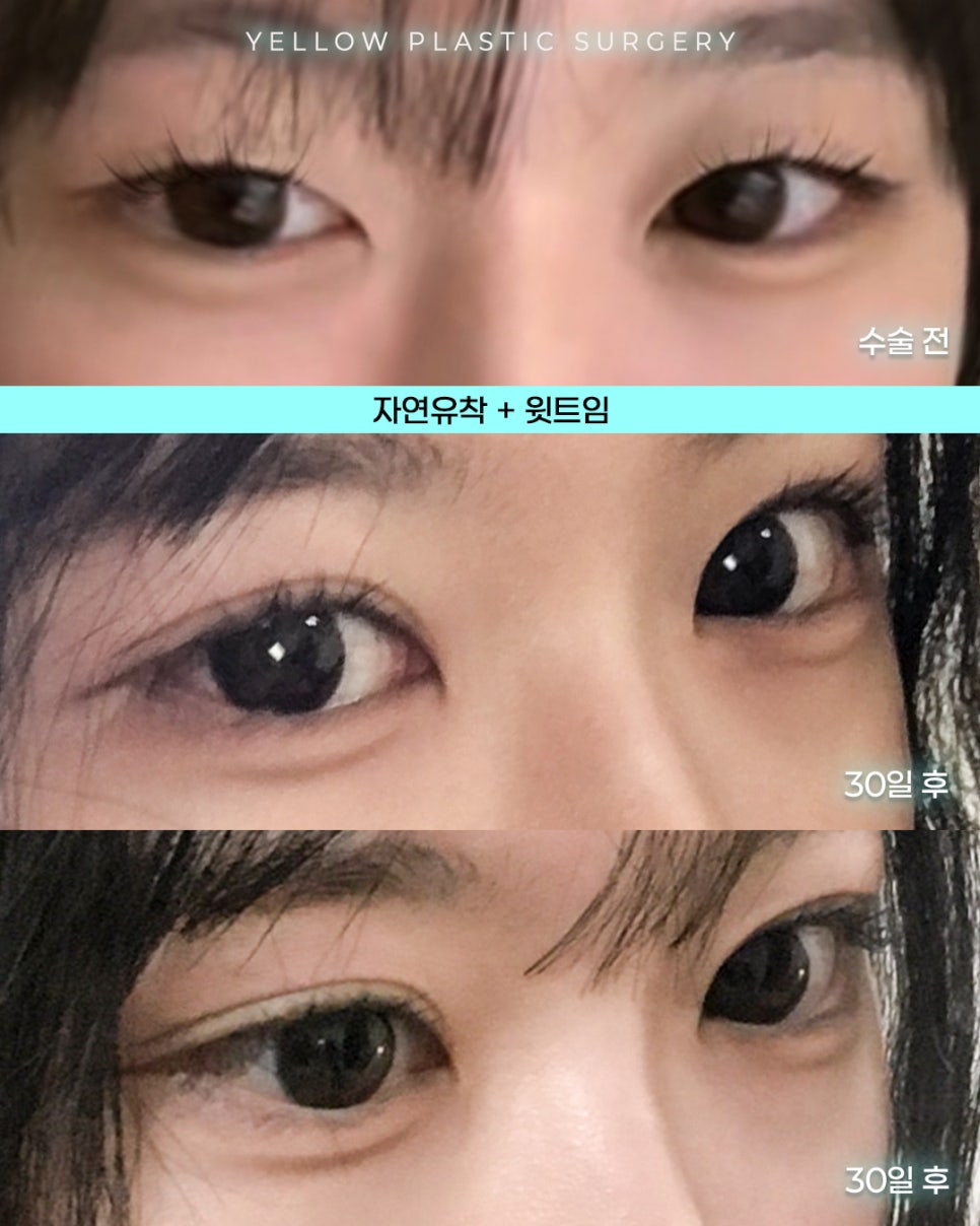 [ 강남역 옐로우성형외과 / 눈성형 ] 자연유착 + 윗트임 관련 이미지 1