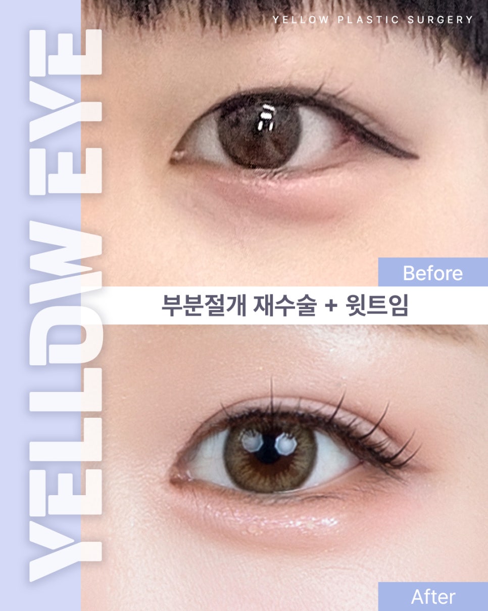 [ 강남역 옐로우성형외과 / 눈성형 ] 부분절개 재수술 + 윗트임 관련 이미지 1