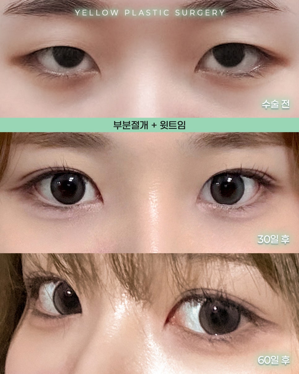 [ 강남역 옐로우성형외과 / 눈성형 ] 부분절개 + 윗트임 관련 이미지 1
