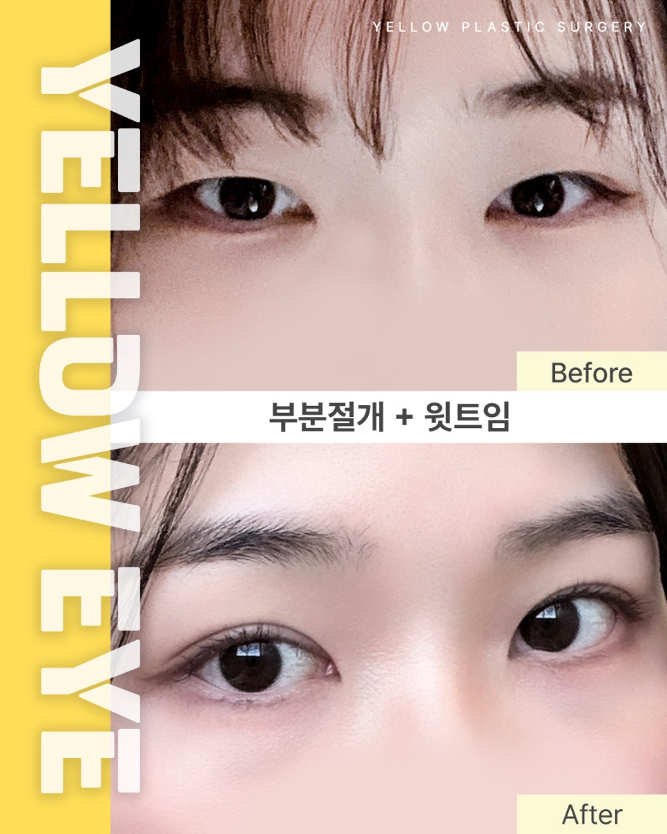 [ Gangnam Station Yellow Plastic Surgery / Eye Surgery ] Partial Incision + Upper Epicanthoplasty image 1
