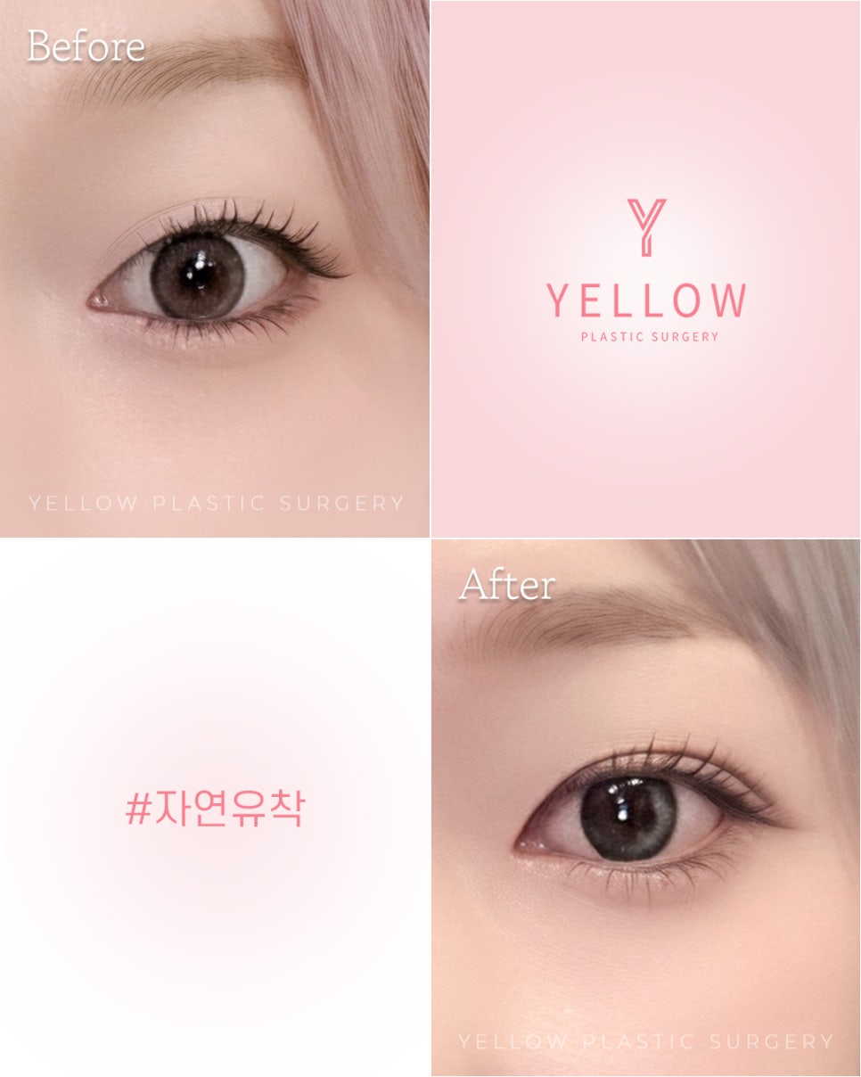 [ Gangnam Station Yellow Plastic Surgery / Eye Surgery ] Natural Adhesion image 1