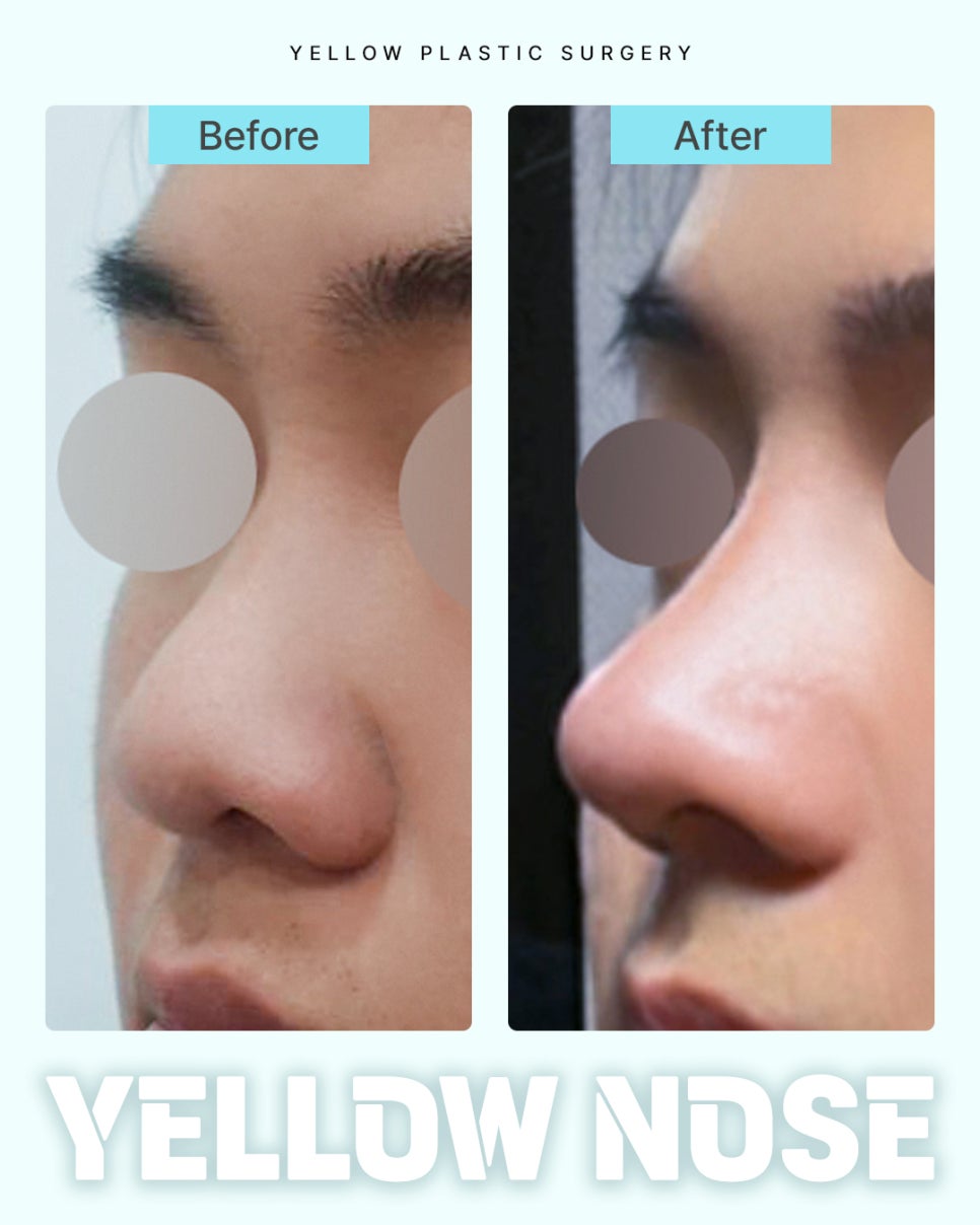 [ Gangnam Station Yellow Plastic Surgery / Rhinoplasty ] image 1