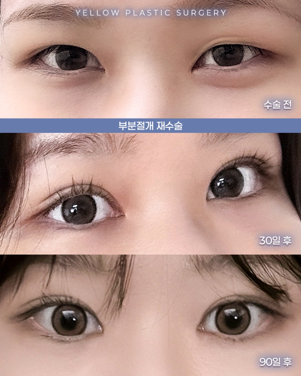 [ 강남역 옐로우성형외과 / 눈성형 ] 부분절개 재수술 관련 이미지 1