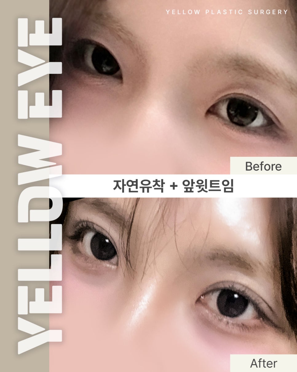 [ 강남역 옐로우성형외과 / 눈성형 ] 자연유착 + 앞윗트임 관련 이미지 1