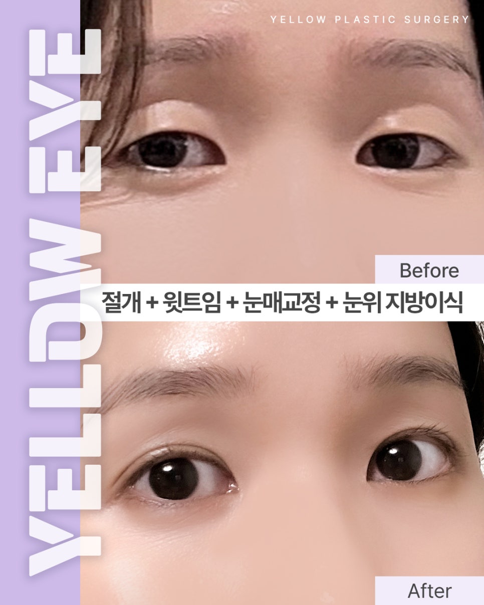 [ 강남역 옐로우성형외과 / 눈성형 ] 절개 + 윗트임 + 눈재교정 + 눈위 지방이식 관련 이미지 1