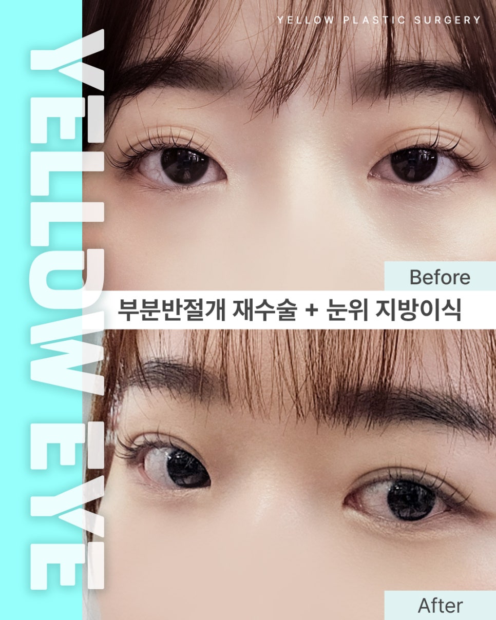 [ Gangnam Station Yellow Plastic Surgery / Eye Surgery ] Partial Incision Revision Surgery + Upper Eyelid Fat Grafting image 1